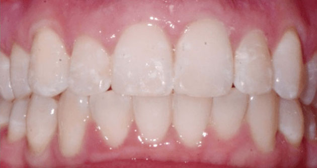 After treatment 2