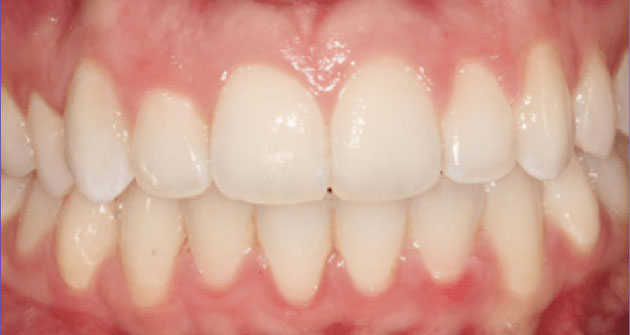After treatment 3
