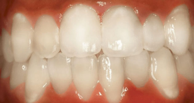 After treatment 4